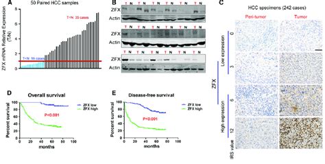 ZFX Is Frequently Upregulated In HCC Tissues And Predicts Poor