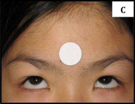 [PDF] Normal distribution of palpebral fissure lengths in Canadian school age children ...