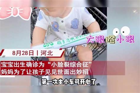 宝宝出生确诊“小睑裂综合征”，妈妈贴胶带让娃见世面：太可爱