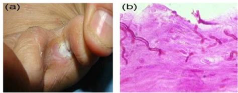 Skin Rash Intertrigo