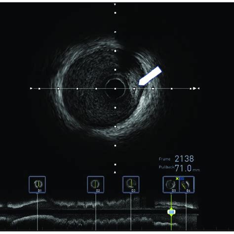 Intravascular Ultrasound Ivus Of The Dissected Left Anterior Download Scientific Diagram