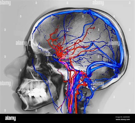 Normal Brain Blood Supply Coloured Magnetic Resonance Imaging Mri