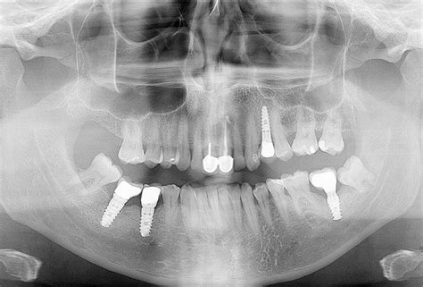 Dental Implant Removal - Dental Implant Center