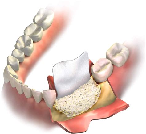 Qu Es Injerto De Hueso Dental Tipos Y Para Qu Sirve