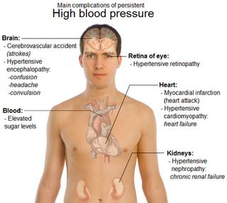 natural cures for blood pressure: High Blood Pressure Signs and Symptoms