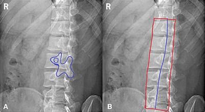 Lumbar X Ray Technique