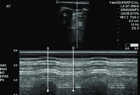 Picture Of Pneumothorax M Mode Ultrasound