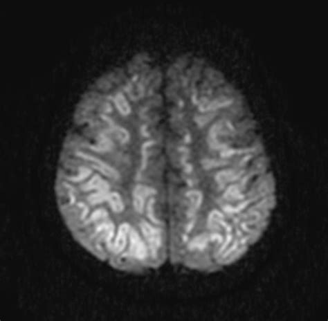 Anoxic Brain Injury Image