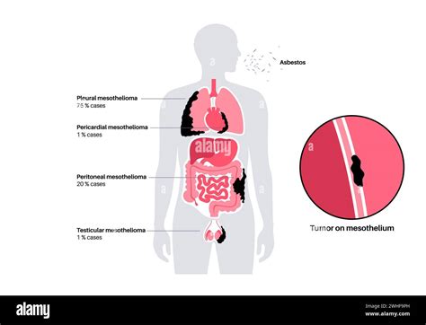 Mesothelioma Tumour Types Illustration Stock Photo Alamy