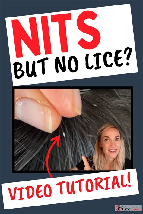 What Lice Eggs And Nits Look Like Video Tutorial Artofit