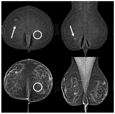 Diagnostics Free Full Text Contrast Enhanced Mammography CEM