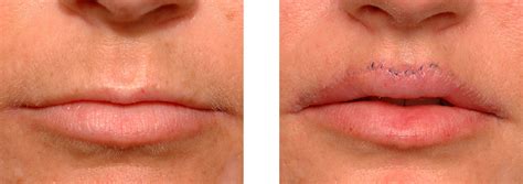 Lip Lifts - An Alternative to Injectable Fillers - Explore Plastic Surgery