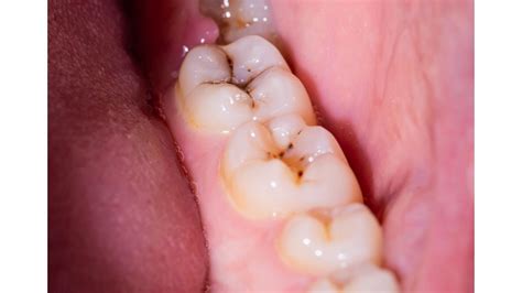 Entender las caries Causas tratamiento y prevención