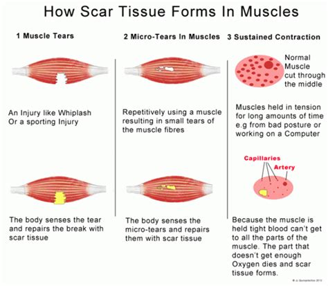 scar-tissue — Back to Health Wellness Centre