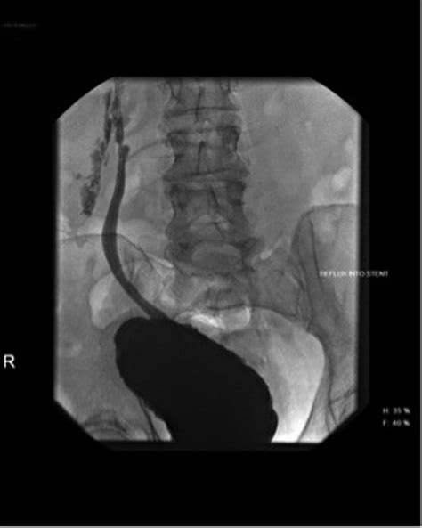 Fluoroscopic Image Obtained During Video Urodynamics Confirming