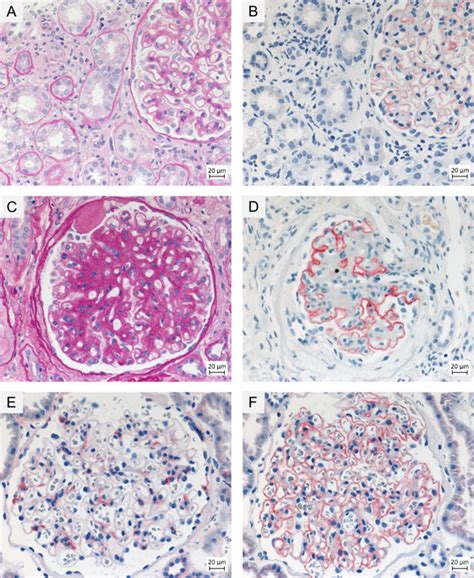 Diagnostic Role Of Renal Biopsy In PLA2R1 Antibody Positive Patients