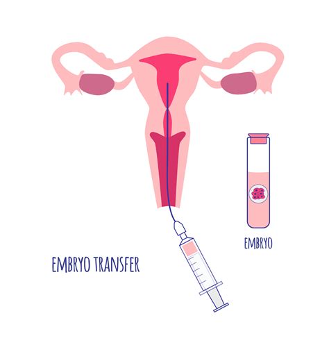 The Complete Guide To IVF Embryo Transfer