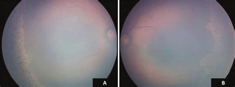 Color Fundus Photographs Of The Right A And Left B Eye After Laser