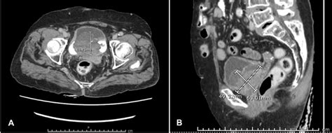 Axial A And Sagittal B Ct Scans Of The Whole Abdomen Included The