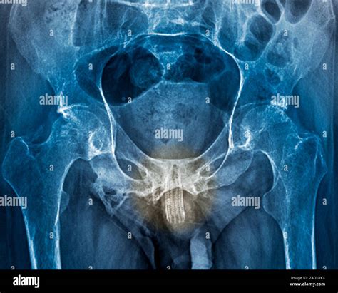 Urethral Stent Coloured Frontal X Ray Of A Section Through The Pelvic