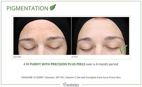 Vi Peelpigmentation 1 Dean Dermatology And Skin Therapy