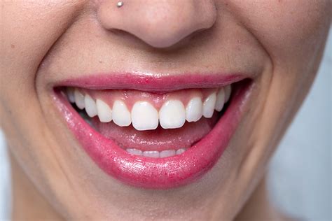 Consejos para evitar una gingivitis Clínica Blanc