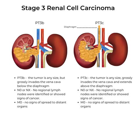 Stage 3 RCC T3b and T3c - KCCure