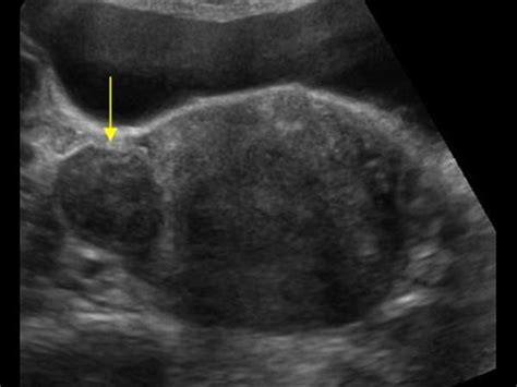 Gynaecology 3 1 Uterus Case 3 1 1 Uterine Fibroids Ultrasound Cases