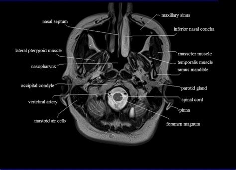 Cranial Bone Anatomy Ct Axial