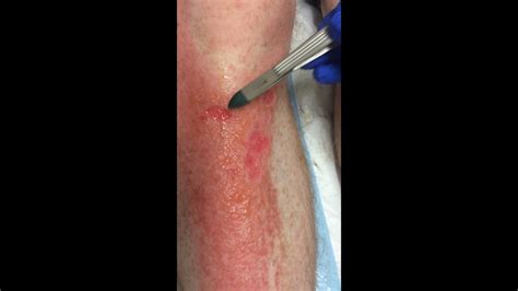 Capillary Return In Minor Superficial Burns Youtube