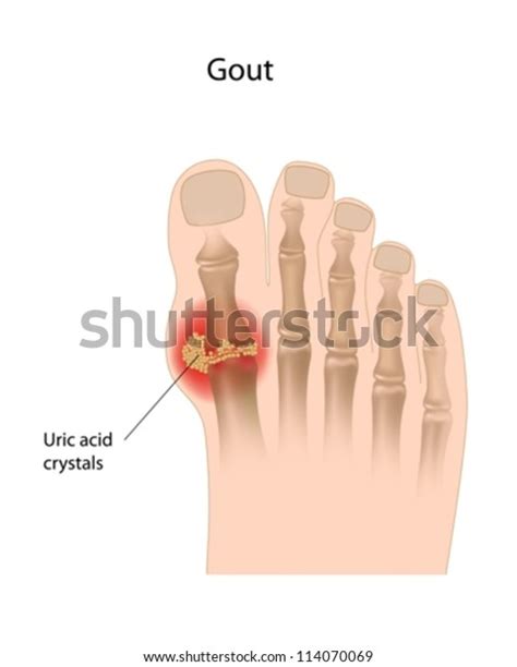 Gout Big Toe Stock Vector (Royalty Free) 114070069