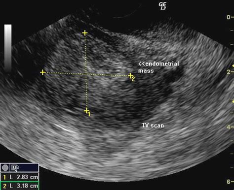 Wk 4 L 1 Pic 2 Transabdominal And Transvaginal Sonography Of The Uterus