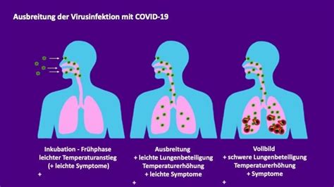 Corona Virus Fr Herkennung Covid Cardiopraxis