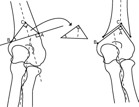 Reverse V Osteotomy Of The Distal Humerus For The Correction Of Cubitus