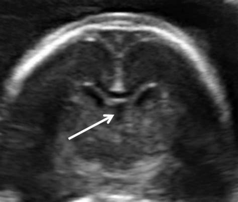 How To Image The Fetal Corpus Callosum Youssef 2013 Ultrasound In