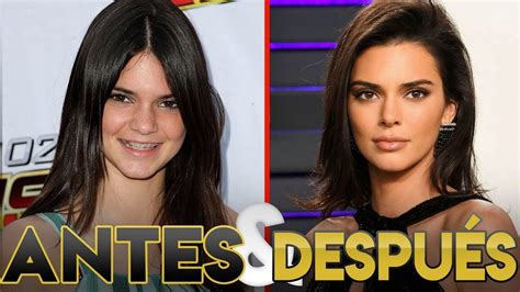 Kendall Jenner Transformación Antes Y Después Cirugías Estéticas