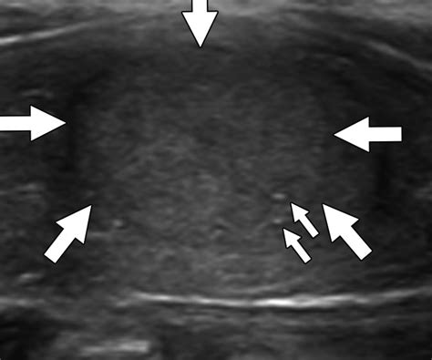 Assessment Of The American College Of Radiology Thyroid Imaging