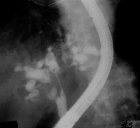 Endoscopic Retrograde Cholangiopancreatography With Cholangiogram Of