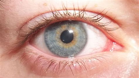 I Have Central Heterochromia Which Causes My Eyes To Have A Yellow Ring