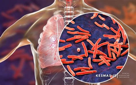 Kenali Gejala Tuberkulosis Cegah Infeksi Sejak Dini