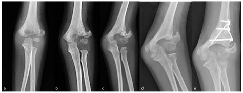 Lateral Condyle Fracture Milch