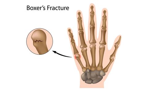 Different Types Of Hand Fractures