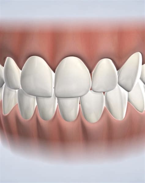 ICON Resin Infiltration Majidian Dental Fargo ND