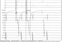 Abbildungen und Graphiken EKG Beispiel Plötzlicher Herztod und AV