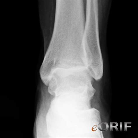 Ankle Dislocation Cases | eORIF