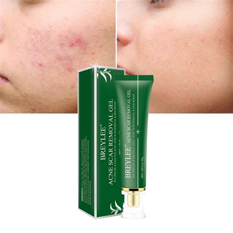 Breylee Acne Scar Removal Gel