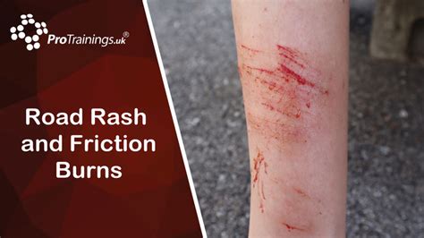 Road Rash And Friction Burns First Aid For Cyclists Level 2 Vtq