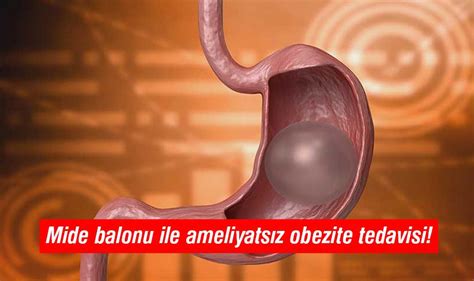 Mide balonu ile ameliyatsız obezite tedavisi Yenigün Gazetesi