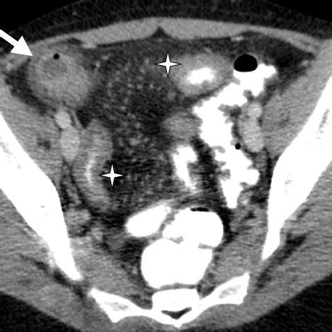 Preoperative Computed Tomography Scanner Showing A Cm Abscess In