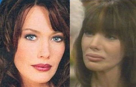 Celebrity Plastic Surgery Before After Pics Botched Plastic